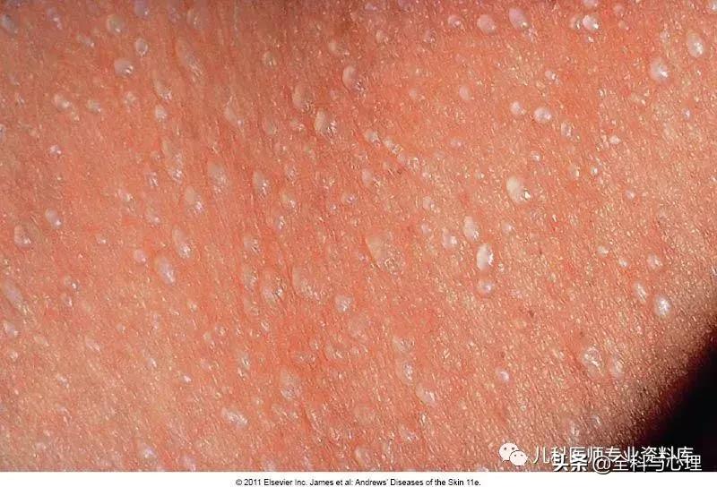 儿童痱子和湿疹，千万要分清楚了