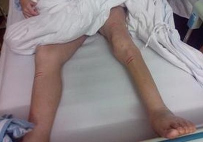 腰椎间盘突出会引起哪里肌肉萎缩,腰椎狭窄突出会导致腿部肌肉萎缩