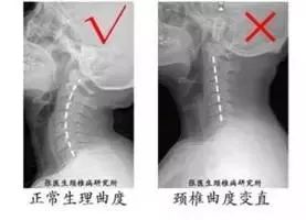 骨科医生颈椎变直怎么办,颈椎曲度变直要看什么科