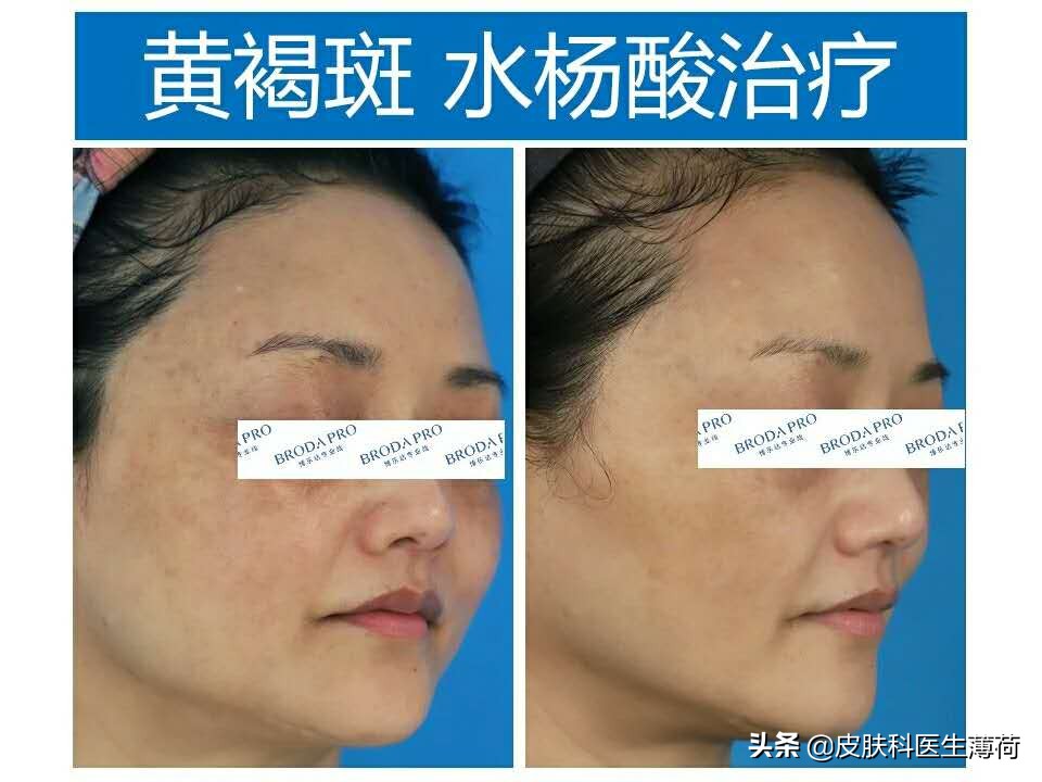 水杨酸精华果酸去闭口粉刺,刷酸去黑头好物推荐