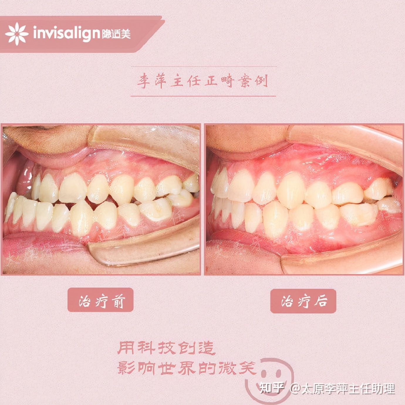 太原矫正牙齿需要做正颌吗,太原牙齿二次矫正