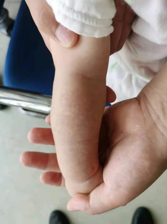 郴州市第一人民医院祛胎记,郴州第一人民医院治疗肝脏血管瘤