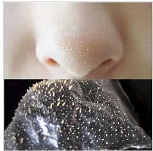 去黑头千万不能踩得雷，不但去不掉还让皮肤伤痕累累，你中了吗