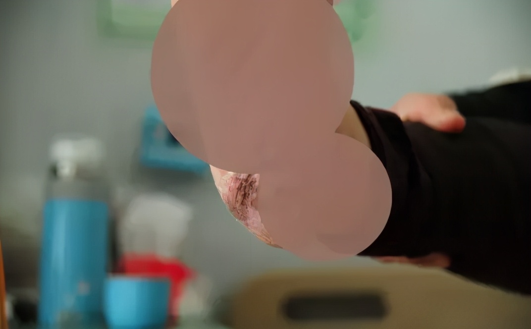 黑痣癌变这个痣是突然出现的么,黑痣凸起会诱发痣癌变是真的吗