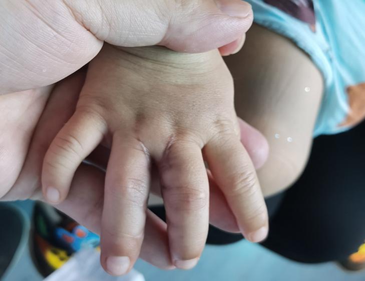 手指植皮后多久可以分指,做并指分指手术复杂吗需要植皮吗