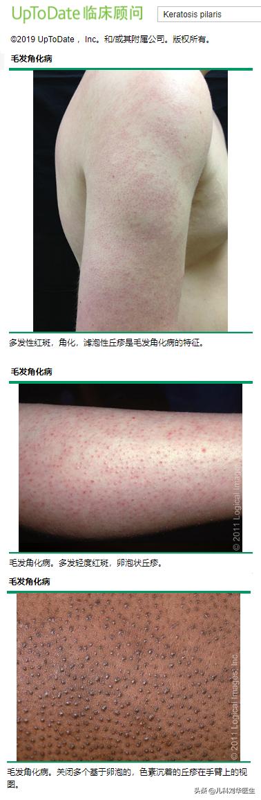 鸡皮状的皮肤病,鸡皮样的疹子是什么病