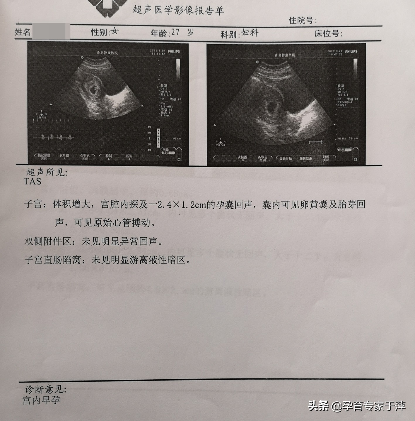 青岛助孕专家于萍：输卵管不孕、多囊，综合治疗喜怀孕