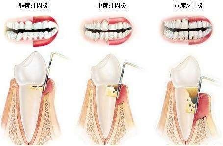 牙龈红肿易出血怎么回事,牙龈出血红肿用什么药治疗