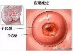 女性必知的七大宫颈癌风险因素,宫颈癌有哪些认识误区