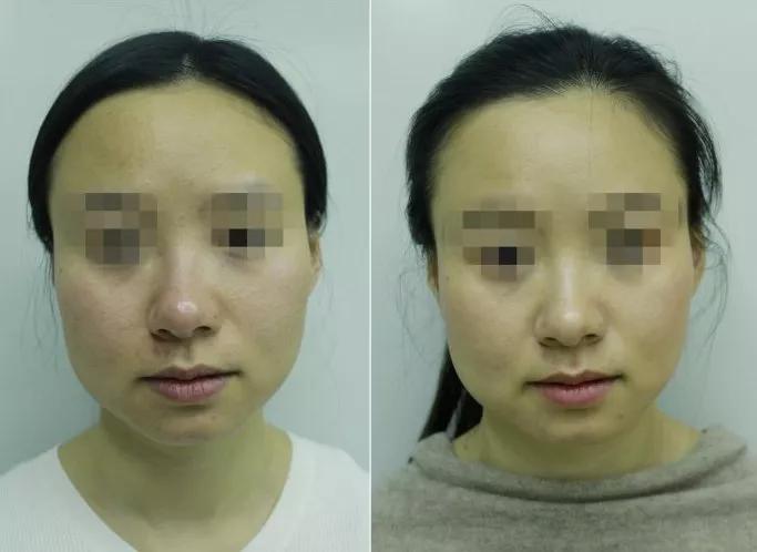 水光针真的比面膜好吗,1次水光等于1000张面膜