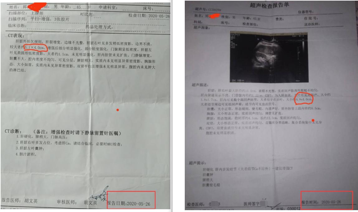 肝癌喝中药肿瘤缩小又转移了,早期肝癌喝中药肿瘤缩小了