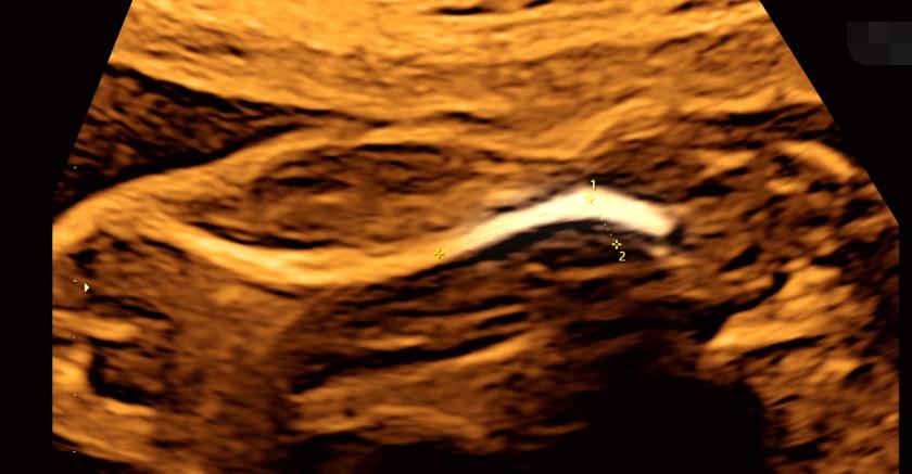 腹中胎儿长出肿瘤，孕妇忍着剧痛，给胎儿打麻药做手术