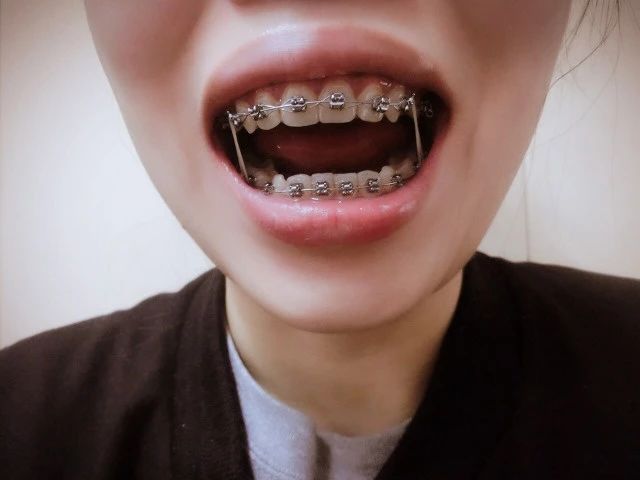 南宁牙齿矫正的每一个详细步骤,儿童的牙齿矫正的步骤
