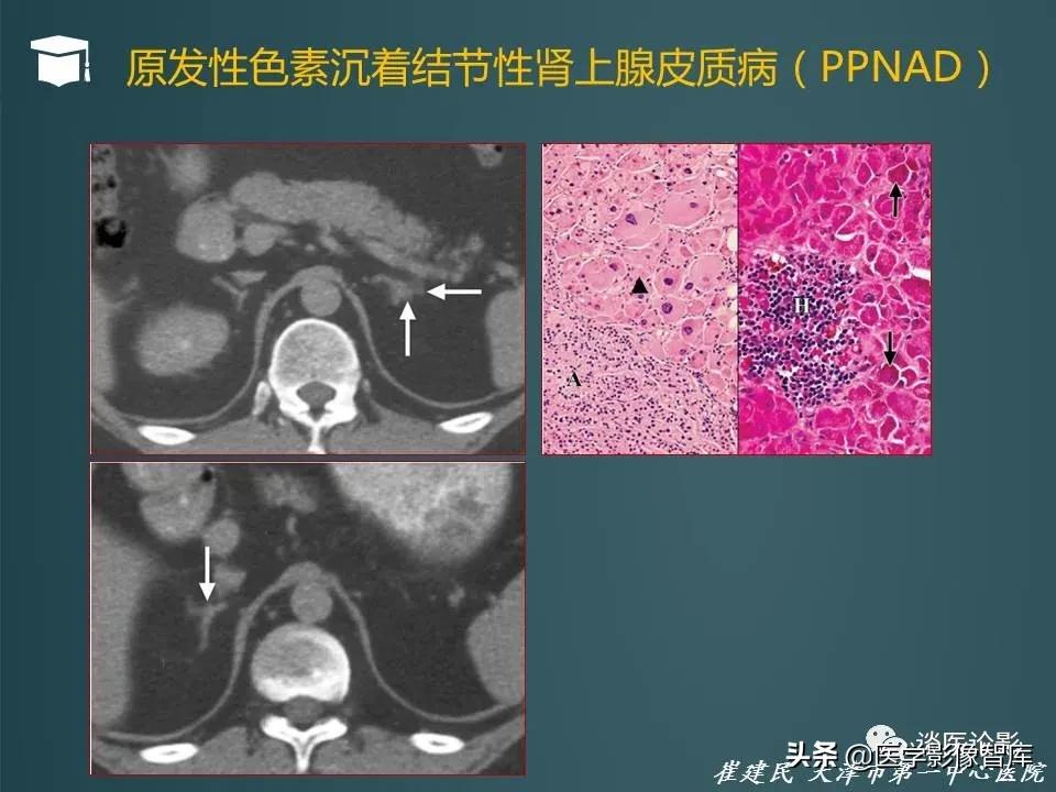 左侧肾上腺结节考虑腺瘤与增生,双侧肾上腺增生是什么原因造成的