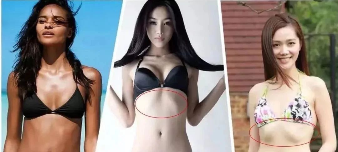 肋骨外翻且胸部突出,肋骨外翻导致胸突出