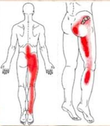 腰椎间盘突出症100问,腰椎间盘突出症保守治疗效果不佳