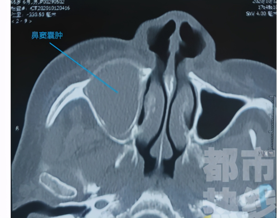鼻窦囊肿导致脸部疼痛怎么办,鼻窦囊肿导致脸颊疼痛