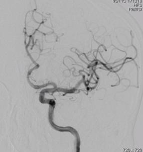 颈内动脉c3段动脉瘤是什么症状,右颈内动脉c3段动脉瘤是什么意思
