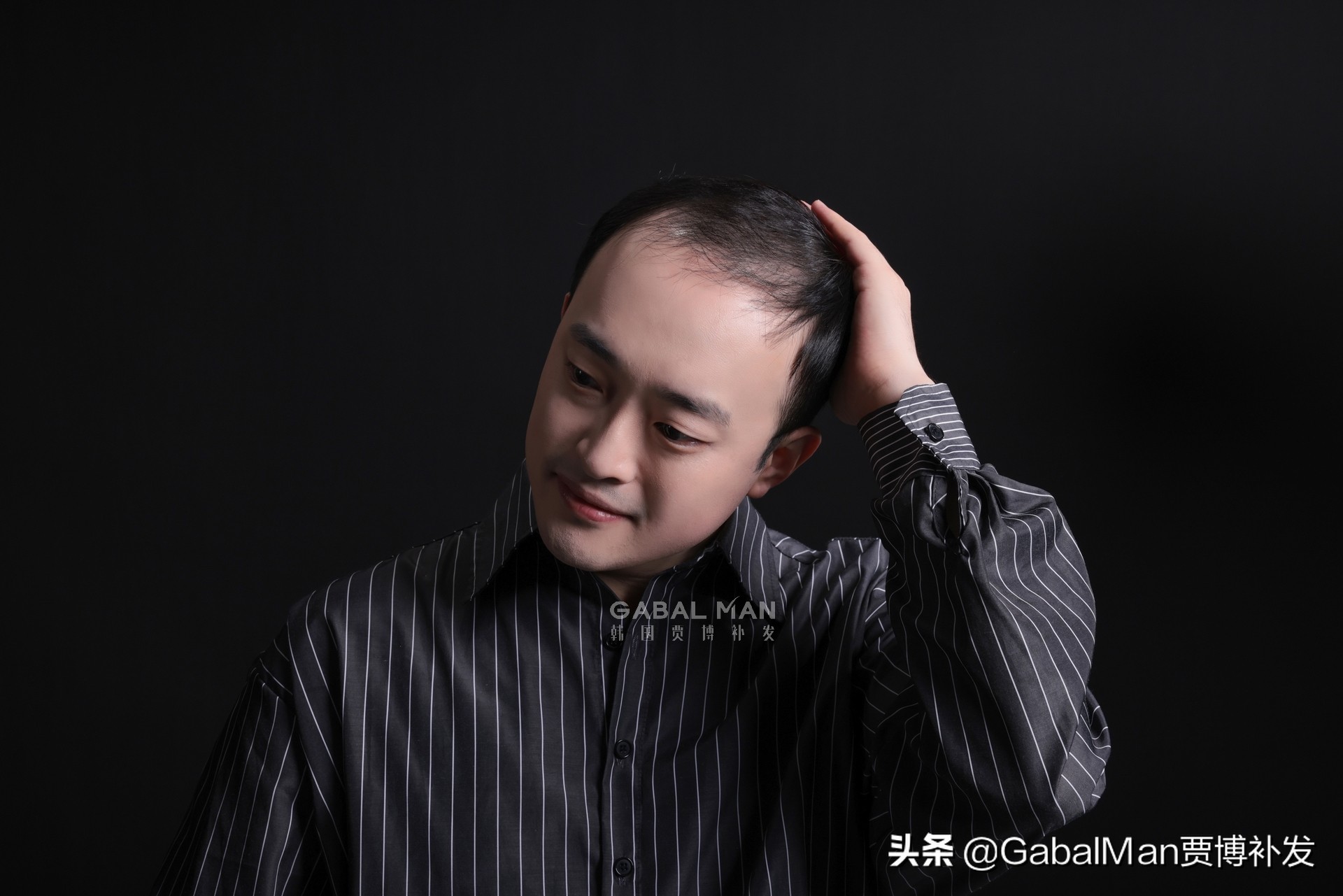 拯救发际线的最佳方法,如何拯救发际线过高