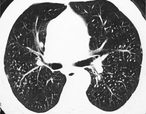 间质性肺疾病看病经验分享,分享肺腺癌临床实验的例子