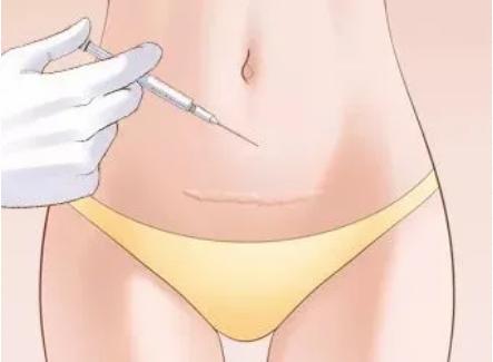 鼻子打疤痕软化针疼吗,打疤痕软化针注意事项