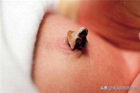 新生儿脐带没有消毒怎么办,脐带绕颈两周怎么办要注意什么