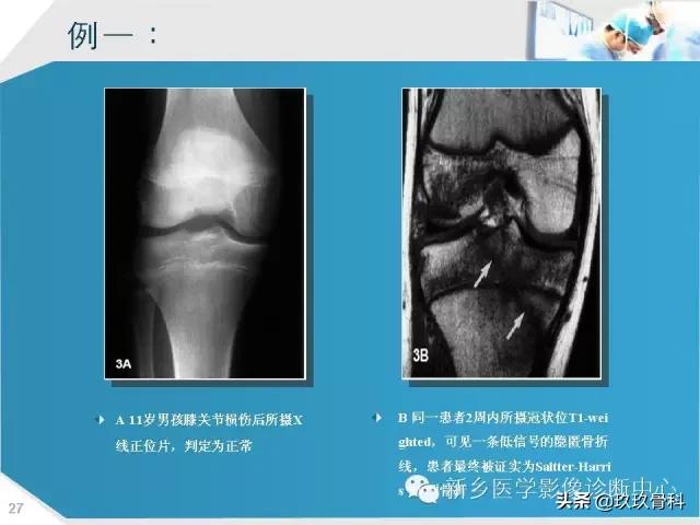 骨骺损伤x线表现,骨骺损伤磁共振表现