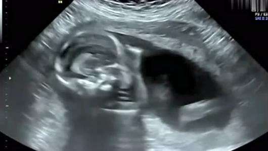 出现先兆流产保胎成功几率多大,有先兆流产现象想要保胎该怎么做