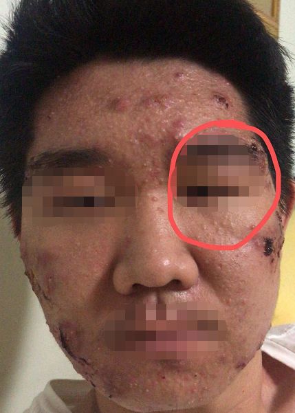 屏障受损起闭口粉刺多长时间能好,不要小看了闭口粉刺