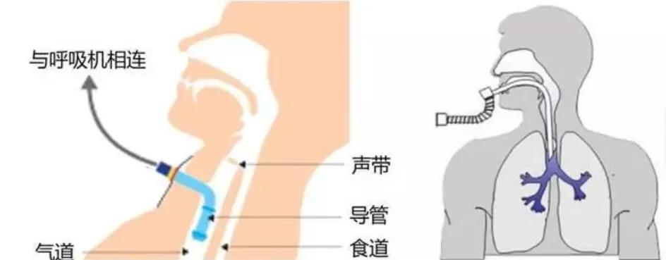 icu对患者实施必要的保护性治疗吗,icu生命支持系统