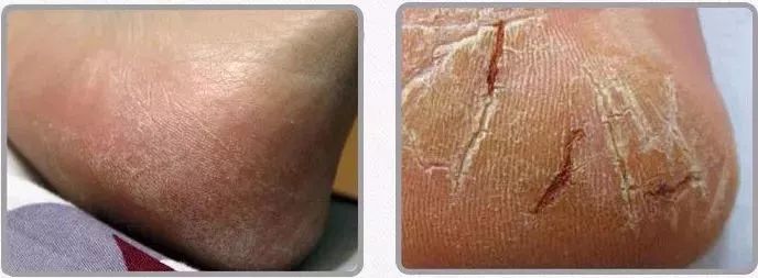 后脚跟干裂护足霜排行榜第一名,护脚霜脚后跟干裂修复霜国货