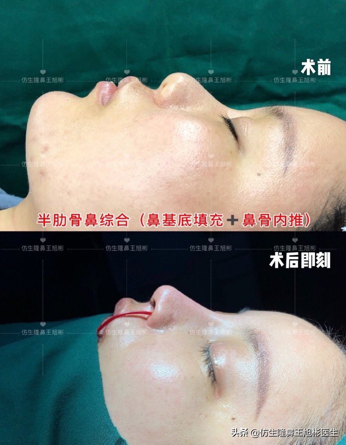 鼻头部位整形,鼻头圆钝高鼻梁整形案例