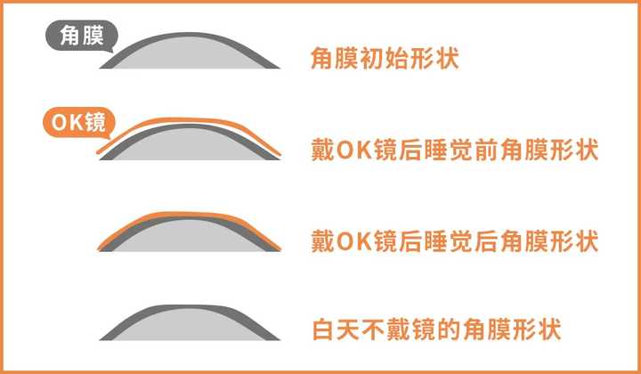 greenlife叶黄素能缓解近视吗,叶黄素矫正近视的眼贴