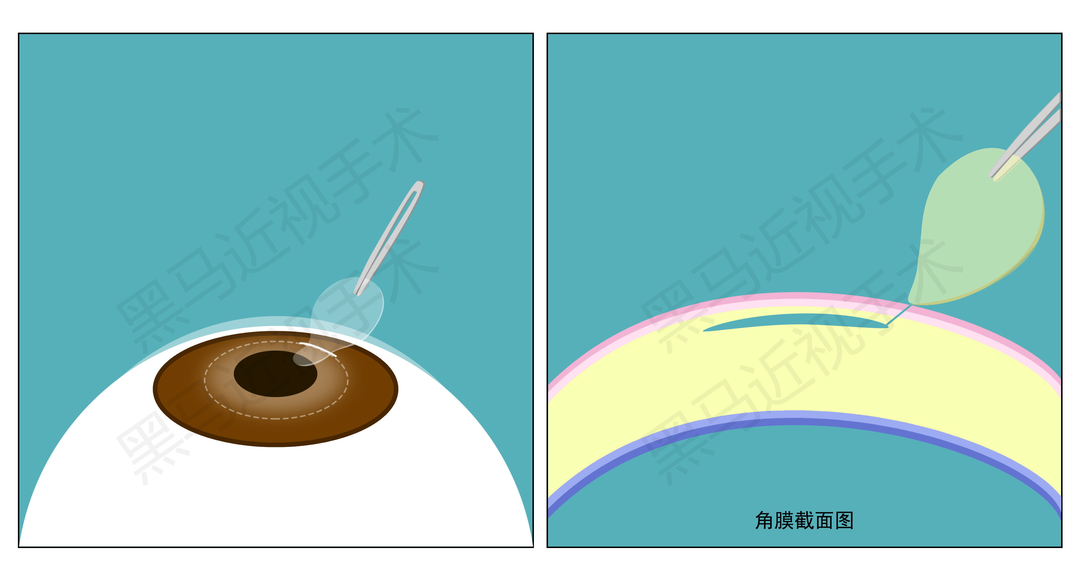 近视300度做激光手术会有后遗症吗,激光近视手术的后遗症有哪些知乎