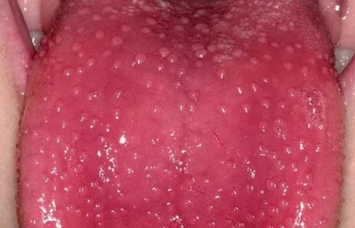 猩红热是皮肤病吗,猩红热样皮炎会传染吗