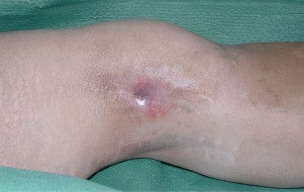 骨髓炎与慢性骨髓炎的区别,骨髓炎的解决方法