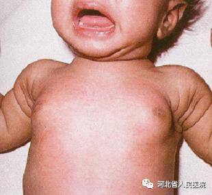 盘点新生儿特有的体征“符号”