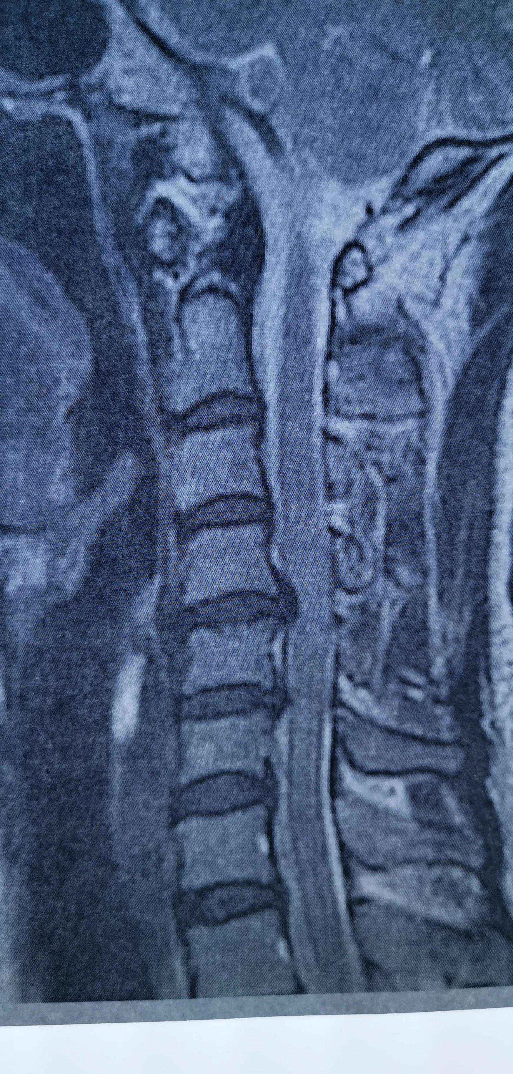 颈椎椎间盘轻度切除,颈椎全切除