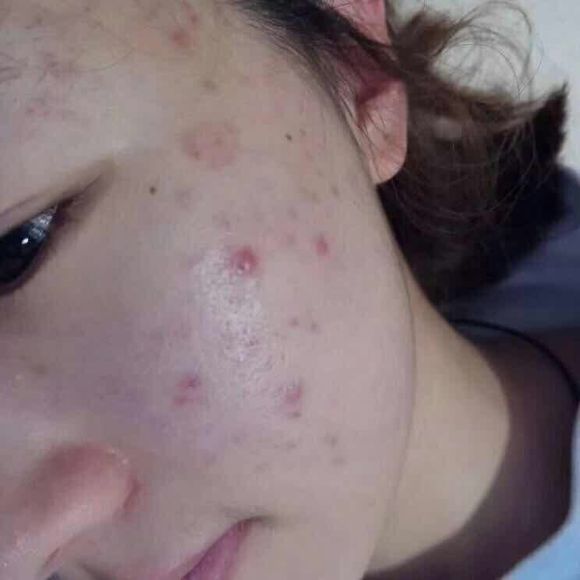 青春痘的护理方法及注意事项,如何预防和治疗青春痘最有效