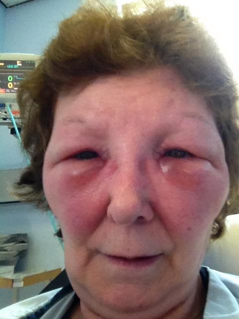 英国女子被假医生注射肉毒杆菌，脸部肿胀像外星人，差点丧命