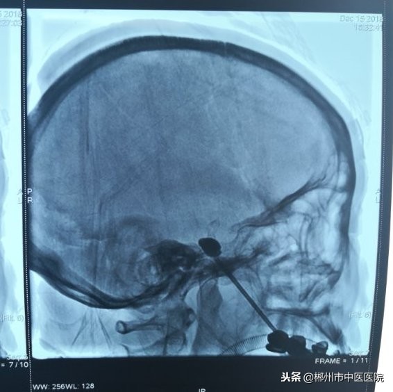 90多岁奶奶全身痛怎么治疗,七十多岁的老奶奶疼得撕心裂肺