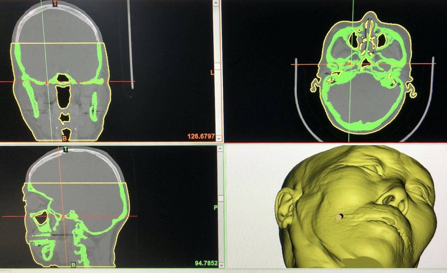 10分钟治好了复发的三叉神经痛？3D医疗打印技术立了大功