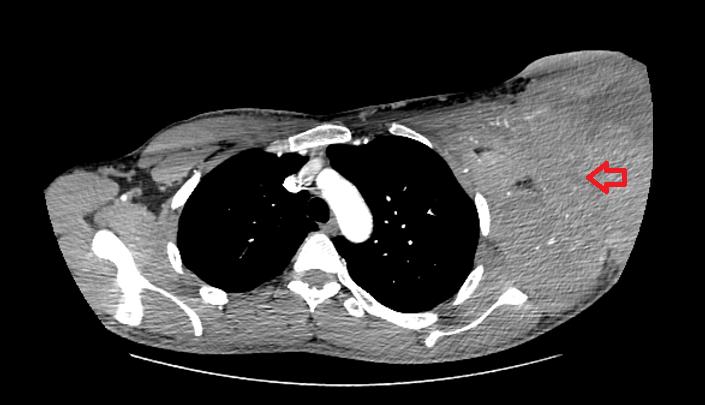 男38岁后背靠腋下内侧有一硬块,男孩腋窝底下有包块