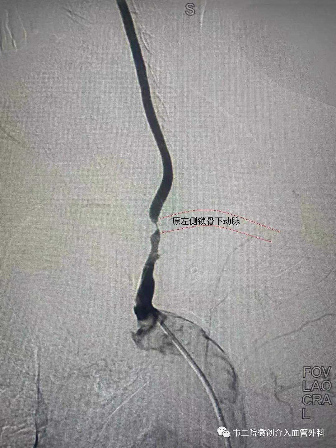 渭南二院血管外科专家,渭南市中心医院脑血管介入手术