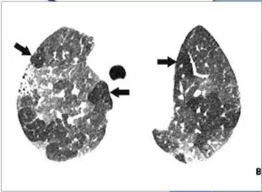 肺部ct十大征象,肺部ct正常图和异常图的区别