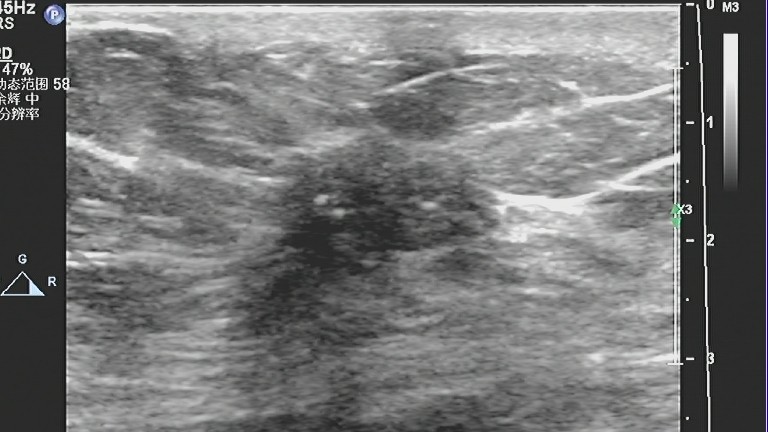 乳腺癌彩超能看出淋巴异常吗,乳腺结节和乳腺癌彩超区别