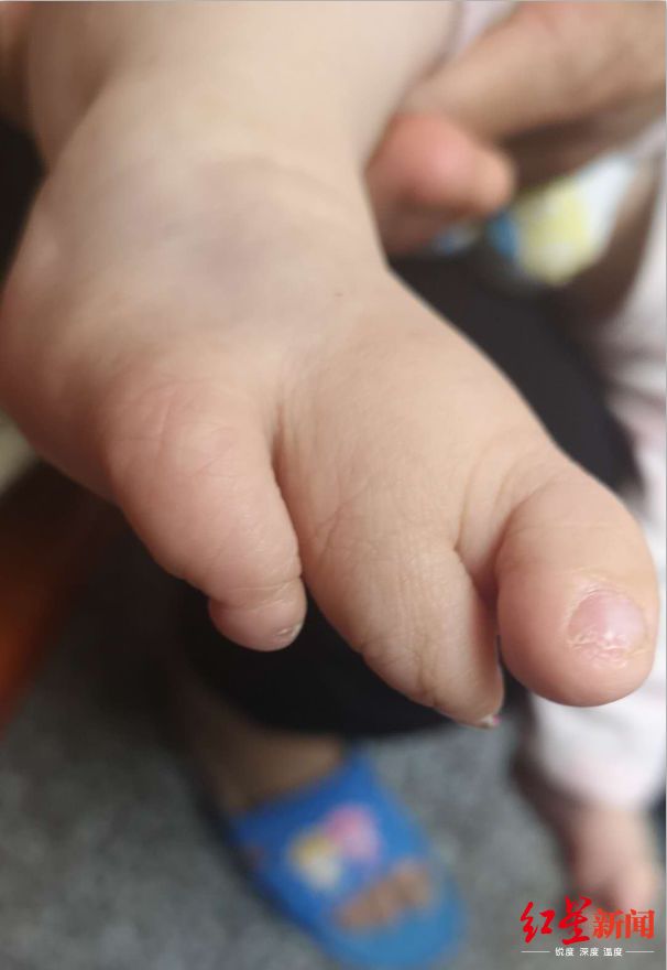 孕妇检查出双胞胎却生下五胞胎,孕妇检查30多次出生宝宝畸形