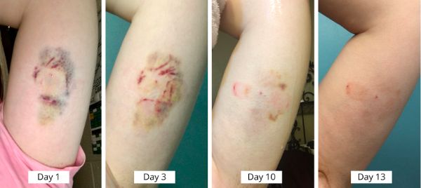 在美国做妇科手术,在美国做什么避孕手术