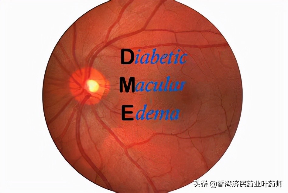 糖尿病视网膜病变的新药,糖尿病肾病新药口服药