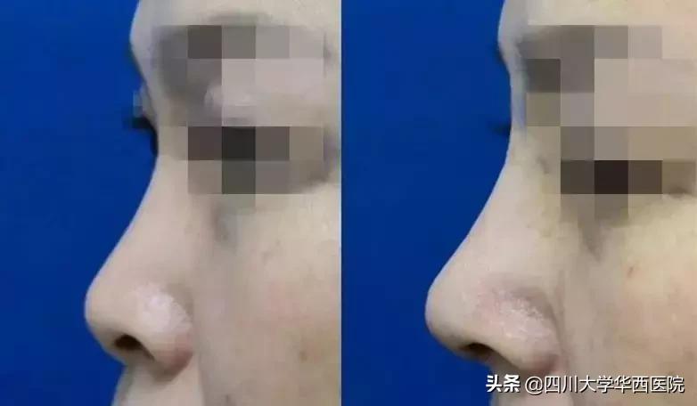 鼻子特别大怎么修,鼻子大如何修鼻子